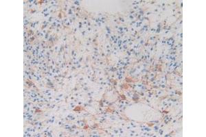 IHC-P analysis of Human Glioma Tissue, with DAB staining. (CRYAB antibody  (AA 1-175))