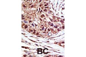 Formalin-fixed and paraffin-embedded human cancer tissue reacted with USP14 polyclonal antibody  , which was peroxidase-conjugated to the secondary antibody, followed by AEC staining . (USP14 antibody  (N-Term))