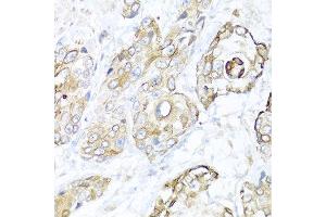 Immunohistochemistry of paraffin-embedded human prostate cancer using NRG4 antibody at dilution of 1:100 (40x lens). (Neuregulin 4 antibody)
