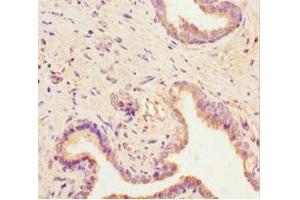 Immunohistochemistry of paraffin-embedded human prostate cancer using ABIN7168723 at dilution of 1:100 (SCAMP2 antibody  (AA 1-153))