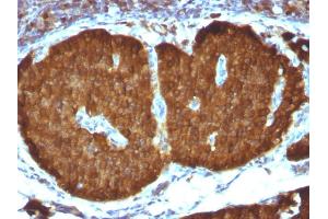 Formalin-fixed, paraffin-embedded human Pheochromocytoma stained with NSE gamma Monoclonal Antibody (ENO2/1375). (ENO2/NSE antibody  (AA 416-433))