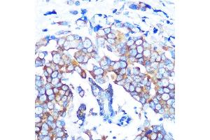 Immunohistochemistry of paraffin-embedded human breast cancer using HD Rabbit mAb (ABIN7267711) at dilution of 1:100 (40x lens). (HDAC6 antibody)