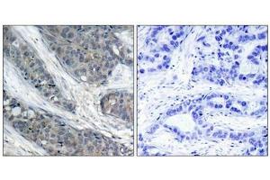 Immunohistochemical analysis of paraffin-embedded human breast carcinoma tissue, using IRS-1 (phospho-Ser307) antibody. (IRS1 antibody  (pSer307))