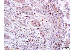 Formalin-fixed and paraffin embedded human lung carcinoma labeled with Anti-phospho-STAT3 (Ser727) Polyclonal Antibody, Unconjugated (ABIN746198) at 1:200 followed by conjugation to the secondary antibody and DAB staining. (STAT3 antibody  (pSer727))