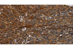 Immunohistochemistry of paraffin-embedded Human cervical cancer tissue using IVL Polyclonal Antibody at dilution 1:50 (Involucrin antibody)