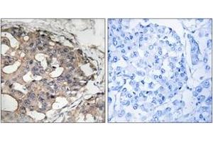 Immunohistochemistry analysis of paraffin-embedded human breast carcinoma tissue, using B-RAF (Ab-446) Antibody.