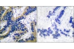 Immunohistochemistry analysis of paraffin-embedded human lung carcinoma tissue, using Caspase 6 (Cleaved-Asp162) Antibody.