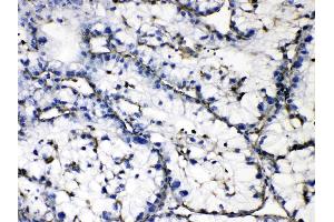GAA was detected in paraffin-embedded sections of human liver cancer tissues using rabbit anti- GAA Antigen Affinity purified polyclonal antibody (Catalog # ) at 1 µg/mL. (GAA antibody  (Middle Region))
