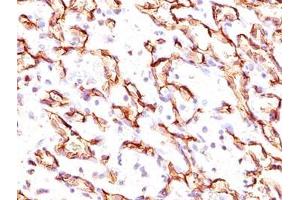 IHC testing of angiosarcoma stained with Podocalyxin antibody.