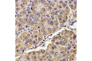 Immunohistochemical analysis of KIF1B staining in human liver cancer formalin fixed paraffin embedded tissue section. (KIF1B antibody)