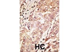 Formalin-fixed and paraffin-embedded human cancer tissue reacted with the primary antibody, which was peroxidase-conjugated to the secondary antibody, followed by AEC staining.