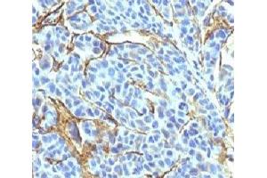 Formalin-fixed, paraffin-embedded human melanoma stained with NGFR antibody (NTR/912). (NGFR antibody)