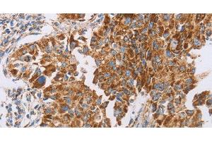 Immunohistochemistry of paraffin-embedded Human lung cancer tissue using GUCY1A3 Polyclonal Antibody at dilution 1:40 (GUCY1A1 antibody)