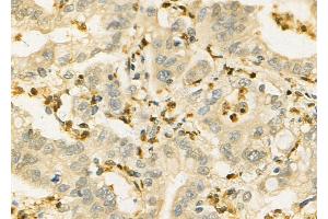 ABIN6257277 and ABIN6275882 at 1/100 staining Human colorectal cancer by IHC-P. (IL-21 antibody  (Internal Region))