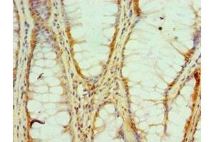 Immunohistochemistry of paraffin-embedded human colon cancer using ABIN7155132 at dilution of 1:100 (HNRNPM antibody  (AA 491-730))