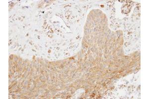 IHC-P Image Immunohistochemical analysis of paraffin-embedded human lung cancer, using SCAP2, antibody at 1:100 dilution. (SKAP2 antibody  (C-Term))