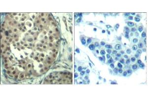 Immunohistochemical analysis of paraffin-embedded human breast carcinoma tissue using Cyclin E1 (Ab-395) Antibody (E021541). (Cyclin E1 antibody)