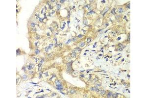 Immunohistochemistry of paraffin-embedded Human liver cancer using TIMM17A Polyclonal Antibody at dilution of 1:100 (40x lens). (TIMM17A antibody)