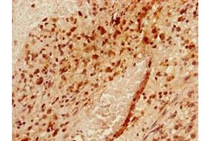 Immunohistochemistry of paraffin-embedded human glioma using ABIN7175954 at dilution of 1:100