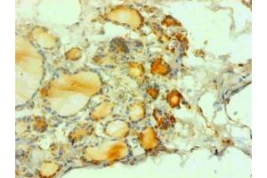 Immunohistochemical of paraffin-embedded human thyroid tissues using ABIN7162718 at dilution of 1:200 (CGRP antibody)