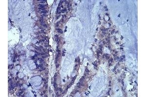 Immunohistochemical analysis of paraffin-embedded colon cancer tissues using LEF1 mouse mAb with DAB staining.