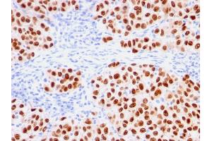 Formalin-fixed, paraffin-embedded human melanoma stained with SOX10-Monospecific Recombinant Mouse Monoclonal Antibody (rSOX10/1074). (Recombinant SOX10 antibody  (AA 115-269))