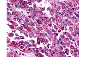 Anti-FZD8 / Frizzled 8 antibody IHC of human Lung, Non-Small Cell Carcinoma. (FZD8 antibody  (N-Term))