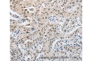 Immunohistochemistry of Human cervical cancer using CDC27 Polyclonal Antibody at dilution of 1:50 (CDC27 antibody)