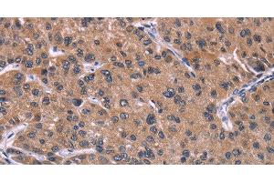 Immunohistochemistry of paraffin-embedded Human prostate cancer tissue using HSD11B2 Polyclonal Antibody at dilution 1:35