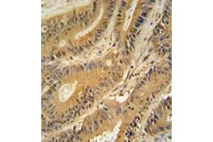 Immunohistochemistry analysis in formalin fixed and paraffin embedded human colon carcinoma reacted with GNAT3 Antibody (Center) followed  which was peroxidase-conjugated to the secondary antibody, followed by DAB staining. (GNAT3 antibody  (Middle Region))