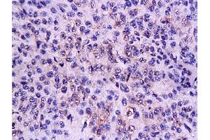 Formalin-fixed and paraffin embedded mouse lymphoma tissue labeled Anti-CD3 Polyclonal Antibody, Unconjugated (ABIN672921) 1:200, followed by conjugation to the secondary antibody and DAB staining