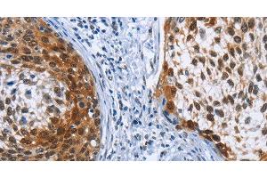 Immunohistochemistry of paraffin-embedded Human cervical cancer tissue using CRABP2 Polyclonal Antibody at dilution 1:40 (CRABP2 antibody)