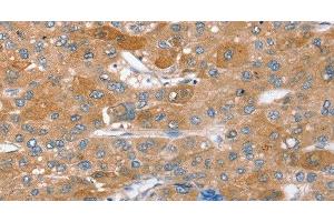 Immunohistochemistry of paraffin-embedded Human liver cancer using STX2 Polyclonal Antibody at dilution of 1:40 (STX2 antibody)