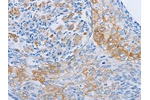 The image on the left is immunohistochemistry of paraffin-embedded Human cervical cancer tissue using ABIN7189704(ADRB3 Antibody) at dilution 1/60, on the right is treated with synthetic peptide. (ADRB3 antibody)