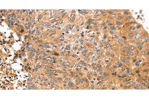 Immunohistochemistry of paraffin-embedded Human esophagus cancer tissue using ABCC9 Polyclonal Antibody at dilution 1:50 (ABCC9 antibody)