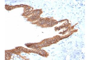 Formalin-fixed, paraffin-embedded human Pancreatic Carcinoma stained with TACSTD2 / TROP2 Mouse Monoclonal Antibody (TACSTD2/2152).