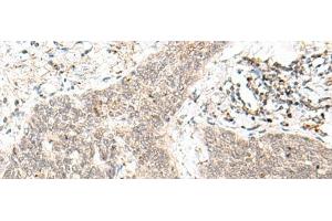 Immunohistochemistry of paraffin-embedded Human esophagus cancer tissue using FAM84B Polyclonal Antibody at dilution of 1:70(x200) (FAM84B antibody)