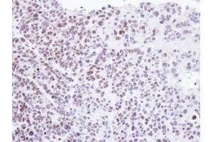 IHC-P Image Immunohistochemical analysis of paraffin-embedded SW480 xenograft , using Homeobox-containing protein 1, antibody at 1:500 dilution. (HMBOX1 antibody)