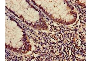 Immunohistochemistry of paraffin-embedded human colon cancer using ABIN7158683 at dilution of 1:100 (KARS antibody  (AA 101-400))