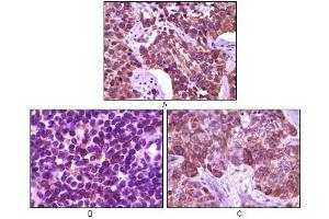 Immunohistochemical analysis of paraffin-embedded human lung carcinoma (A), lymph tissue (B) and skin carcinoma (C), showing membrane localization using BLK antibody with DAB staining. (BLK antibody)