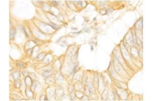 Immunohistochemical staining of Human Intestines Cancer (FGFR2 antibody  (C-Term))