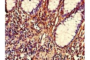 Immunohistochemistry of paraffin-embedded human colon cancer using ABIN7161922 at dilution of 1:100 (NRIP2 antibody  (AA 1-281))