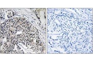 Immunohistochemistry analysis of paraffin-embedded human breast carcinoma tissue, using MRPL24 Antibody. (MRPL24 antibody  (AA 101-150))