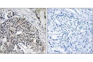 Immunohistochemistry analysis of paraffin-embedded human breast carcinoma tissue, using MRPL24 Antibody.