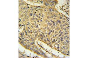 AGER Antibody (N-term) (ABIN651054 and ABIN2840050) IHC analysis in formalin fixed and paraffin embedded human lung carcinoma followed by peroxidase conjugation of the secondary antibody and DAB staining. (RAGE antibody  (N-Term))