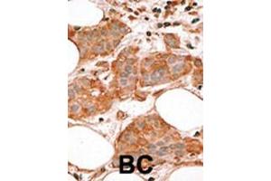 Formalin-fixed and paraffin-embedded human cancer tissue reacted with the primary antibody, which was peroxidase-conjugated to the secondary antibody, followed by AEC staining. (BCL2L14 antibody  (AA 194-229))