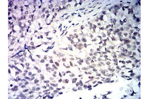 Immunohistochemical analysis of paraffin-embedded bladder cancer tissues using MDM2 mouse mAb with DAB staining. (MDM2 antibody  (AA 26-169))