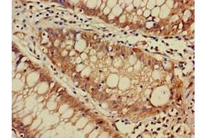 Immunohistochemistry of paraffin-embedded human colon cancer using ABIN7150558 at dilution of 1:100 (DNAJC4 antibody  (AA 1-155))