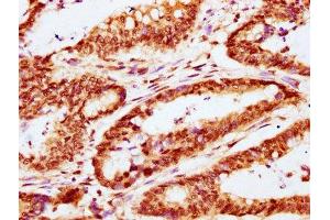 IHC image of ABIN7146274 diluted at 1:400 and staining in paraffin-embedded human colon cancer performed on a Leica BondTM system. (CABIN1 antibody  (AA 1978-2123))
