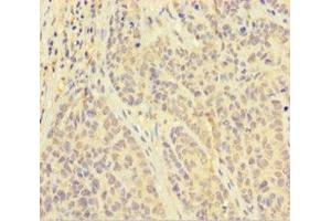 Immunohistochemistry of paraffin-embedded human ovarian cancer using ABIN7162611 at dilution of 1:100 (PAPPA antibody  (AA 95-302))